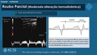 Roubo Parcial (Moderada alteração hemodinâmica)
 fluxo parcialmente reverso
Rev bras ecocardiogr imagem cardiovasc. 2012;25(4):298-301
Doppler - vertebrais
 
