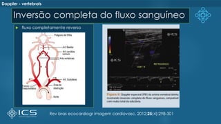 Inversão completa do fluxo sanguíneo
 fluxo completamente reverso
Rev bras ecocardiogr imagem cardiovasc. 2012;25(4):298-301
Doppler - vertebrais
 