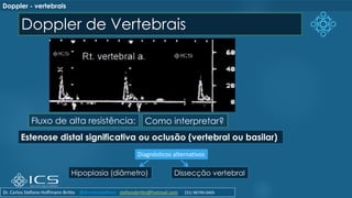 Doppler de Vertebrais
Fluxo de alta resistência:
Estenose distal significativa ou oclusão (vertebral ou basilar)
Hipoplasia (diâmetro) Dissecção vertebral
Como interpretar?
Diagnósticos alternativos
Doppler - vertebrais
Dr. Carlos Stéfano Hoffmann Britto @drcarlosstefano stefanobritto@hotmail.com (31) 98799-0405
 