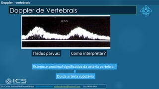 Doppler de Vertebrais
Tardus parvus:
Estenose proximal significativa da artéria vertebral
Ou da artéria subclávia
Como interpretar?
Doppler - vertebrais
Dr. Carlos Stéfano Hoffmann Britto @drcarlosstefano stefanobritto@hotmail.com (31) 98799-0405
 