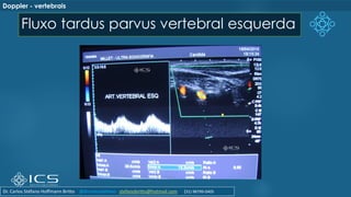 Fluxo tardus parvus vertebral esquerda
Doppler - vertebrais
Dr. Carlos Stéfano Hoffmann Britto @drcarlosstefano stefanobritto@hotmail.com (31) 98799-0405
 