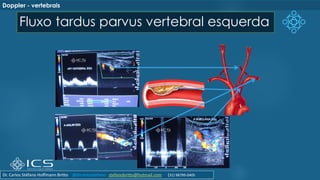 Fluxo tardus parvus vertebral esquerda
Doppler - vertebrais
Dr. Carlos Stéfano Hoffmann Britto @drcarlosstefano stefanobritto@hotmail.com (31) 98799-0405
 