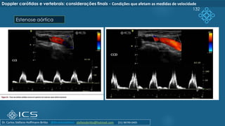 132
Doppler carótidas e vertebrais: considerações finais - Condições que afetam as medidas de velocidade
Estenose aórtica
Dr. Carlos Stéfano Hoffmann Britto @drcarlosstefano stefanobritto@hotmail.com (31) 98799-0405
 