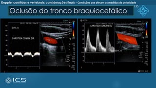Oclusão do tronco braquiocefálico
135
Doppler carótidas e vertebrais: considerações finais - Condições que afetam as medidas de velocidade
 