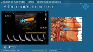 Artéria carótida externa
34
Doppler de Carótidas – rotina – anatomia ecográfica
Dr. Carlos Stéfano Hoffmann Britto @drcarlosstefano stefanobritto@hotmail.com (31) 98799-0405
 