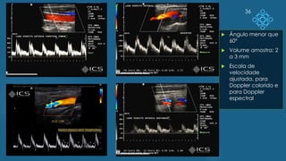 36
 Ângulo menor que
60º
 Volume amostra: 2
a 3 mm
 Escala de
velocidade
ajustada, para
Doppler colorido e
para Doppler
espectral
 