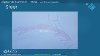 Steer
38
Doppler de Carótidas – rotina – técnica ecográfica
Dr. Carlos Stéfano Hoffmann Britto @drcarlosstefano stefanobritto@hotmail.com (31) 98799-0405
 
