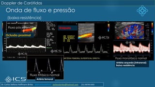 Onda de fluxo e pressão
(baixa resistência)
Fluxo pós estenótico
Doppler de Carótidas
Oclusão proximal
Erisipela
Fluxo trifásico normal
Artéria femoral
Artéria arqueda (intrarenal)
Baixa resistência
Fluxo monofásico normal
Dr. Carlos Stéfano Hoffmann Britto @drcarlosstefano stefanobritto@hotmail.com (31) 98799-0405
 