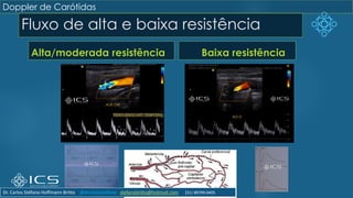 Fluxo de alta e baixa resistência
Alta/moderada resistência Baixa resistência
Doppler de Carótidas
Dr. Carlos Stéfano Hoffmann Britto @drcarlosstefano stefanobritto@hotmail.com (31) 98799-0405
 