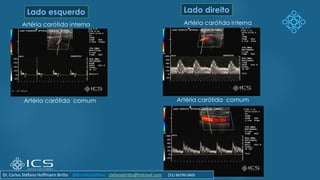Lado esquerdo Lado direito
Artéria carótida interna
Artéria carótida comum Artéria carótida comum
Artéria carótida interna
Dr. Carlos Stéfano Hoffmann Britto @drcarlosstefano stefanobritto@hotmail.com (31) 98799-0405
 