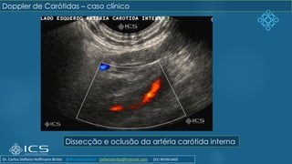 Dissecção e oclusão da artéria carótida interna
Doppler de Carótidas – caso clínico
Dr. Carlos Stéfano Hoffmann Britto @drcarlosstefano stefanobritto@hotmail.com (31) 98799-0405
 