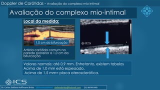 Avaliação do complexo mio-intimal
Local da medida:
Artéria carótida comum na
parede posterior a 1,0 cm da
bifurcação
Valores normais: até 0,9 mm. Entretanto, existem tabelas
Acima de 1,0 mm está espessado.
Acima de 1,5 mm= placa aterosclerótica.
1,0 cm da bifurcação
Doppler de Carótidas - Avaliação do complexo mio-intimal
Dr. Carlos Stéfano Hoffmann Britto @drcarlosstefano stefanobritto@hotmail.com (31) 98799-0405
 