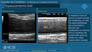 Espessamento EMI
Espessado Normal
a medida manual
ponto a ponto pode
ser realizada, se não
há disponibilidade
da automática.
Devem ser
realizadas no mínimo
cinco medidas de
cada lado para se
obter um valor
médio (EMI média).
Doppler de Carótidas - Avaliação do complexo mio-intimal
Dr. Carlos Stéfano Hoffmann Britto @drcarlosstefano stefanobritto@hotmail.com (31) 98799-0405
 