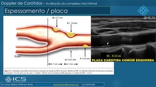 Espessamento / placa
Doppler de Carótidas - Avaliação do complexo mio-intimal
Dr. Carlos Stéfano Hoffmann Britto @drcarlosstefano stefanobritto@hotmail.com (31) 98799-0405
 