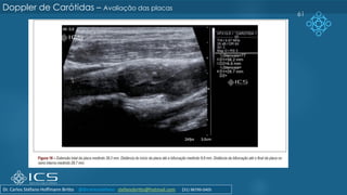 61
Doppler de Carótidas – Avaliação das placas
Dr. Carlos Stéfano Hoffmann Britto @drcarlosstefano stefanobritto@hotmail.com (31) 98799-0405
 