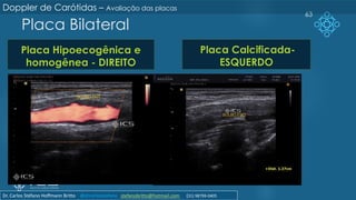 Placa Bilateral
Placa Hipoecogênica e
homogênea - DIREITO
Placa Calcificada-
ESQUERDO
63
Doppler de Carótidas – Avaliação das placas
Dr. Carlos Stéfano Hoffmann Britto @drcarlosstefano stefanobritto@hotmail.com (31) 98799-0405
 