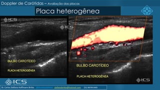 Placa heterogênea
Doppler de Carótidas – Avaliação das placas
Dr. Carlos Stéfano Hoffmann Britto @drcarlosstefano stefanobritto@hotmail.com (31) 98799-0405
 