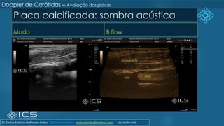 Placa calcificada: sombra acústica
Modo B flow
Doppler de Carótidas – Avaliação das placas
Dr. Carlos Stéfano Hoffmann Britto @drcarlosstefano stefanobritto@hotmail.com (31) 98799-0405
 