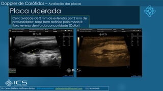 Placa ulcerada
Doppler de Carótidas – Avaliação das placas
Concavidade de 2 mm de extensão por 2 mm de
profundidade; base bem definisa pelo modo B;
fluxo reverso dentro da concavidade (Collor)
Dr. Carlos Stéfano Hoffmann Britto @drcarlosstefano stefanobritto@hotmail.com (31) 98799-0405
 