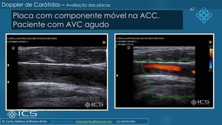 Placa com componente móvel na ACC.
Paciente com AVC agudo
67
Doppler de Carótidas – Avaliação das placas
Dr. Carlos Stéfano Hoffmann Britto @drcarlosstefano stefanobritto@hotmail.com (31) 98799-0405
 