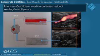 74
Estenoses Carotídeas: medida do lúmen residual
Avaliação Multiplanos
Doppler de Carótidas – Quantificação da estenose - medida direta
Dr. Carlos Stéfano Hoffmann Britto @drcarlosstefano stefanobritto@hotmail.com (31) 98799-0405
 