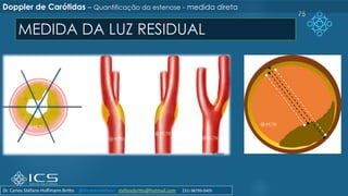 MEDIDA DA LUZ RESIDUAL
75
Doppler de Carótidas – Quantificação da estenose - medida direta
Dr. Carlos Stéfano Hoffmann Britto @drcarlosstefano stefanobritto@hotmail.com (31) 98799-0405
 
