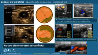 Placas ateromatosas de carótidas
76
Doppler de Carótidas – Quantificação da estenose - medida direta
A- Luz regular e de fácil mensuração por haver
coincidência entre as medidas nos diversos eixos;
B- Luz irregular, com diferentes medidas nos diversos eixos.
DIREITA
Dr. Carlos Stéfano Hoffmann Britto @drcarlosstefano stefanobritto@hotmail.com (31) 98799-0405
 