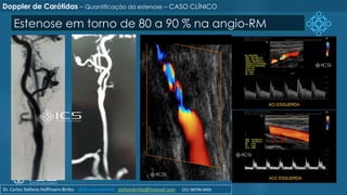 Estenose em torno de 80 a 90 % na angio-RM
Doppler de Carótidas – Quantificação da estenose – CASO CLÍNICO
Dr. Carlos Stéfano Hoffmann Britto @drcarlosstefano stefanobritto@hotmail.com (31) 98799-0405
 