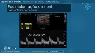 Pós implantação de stent
caso anterior de Estenose
79
Doppler de Carótidas – Quantificação da estenose – CASO CLÍNICO
Dr. Carlos Stéfano Hoffmann Britto @drcarlosstefano stefanobritto@hotmail.com (31) 98799-0405
 