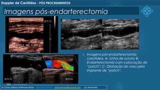 Imagens pós-endarterectomia
➢ Imagens pós-endarterectomia
carotídea. A- Linha de sutura; B-
Endarterectomia com colocação de
“patch”; C- Dilatação do vaso pelo
implante de “patch”.
Doppler de Carótidas – PÓS PROCEDIMENTOS
Dr. Carlos Stéfano Hoffmann Britto @drcarlosstefano stefanobritto@hotmail.com (31) 98799-0405
 