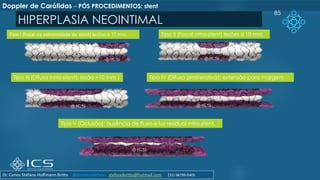 HIPERPLASIA NEOINTIMAL
85
Tipo I (Focal na extremidade do stent) lesões ≤ 10 mm Tipo II (Focal intra-stent) lesões ≤ 10 mm
Tipo III (Difusa intra-stent): lesão >10 mm ) Tipo IV (Difusa proliferativa): extensão para margem
Tipo V (Oclusão): ausência de fluxo e luz residual intra-stent.
Doppler de Carótidas – PÓS PROCEDIMENTOS: stent
Dr. Carlos Stéfano Hoffmann Britto @drcarlosstefano stefanobritto@hotmail.com (31) 98799-0405
 