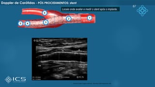 87
Locais onde avaliar e medir o stent após o implante.
Arq Bras Cardiol: Imagem cardiovasc. 2015 Abril; 28(nº especial):e1- e64
Doppler de Carótidas – PÓS PROCEDIMENTOS: stent
 