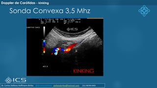 Sonda Convexa 3,5 Mhz
KINKING
Doppler de Carótidas – kinking
Dr. Carlos Stéfano Hoffmann Britto @drcarlosstefano stefanobritto@hotmail.com (31) 98799-0405
 