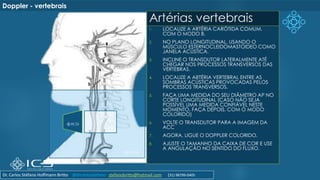 Artérias vertebrais
1. LOCALIZE A ARTÉRIA CARÓTIDA COMUM,
COM O MODO B.
2. NO PLANO LONGITUDINAL, USANDO O
MÚSCULO ESTERNOCLEIDOMASTOIDEO COMO
JANELA ACÚSTICA.
3. INCLINE O TRANSDUTOR LATERALMENTE ATÉ
CHEGAR NOS PROCESSOS TRANSVERSOS DAS
VÉRTEBRAS.
4. LOCALIZE A ARTÉRIA VERTEBRAL ENTRE AS
SOMBRAS ACÚSTICAS PROVOCADAS PELOS
PROCESSOS TRANSVERSOS.
5. FAÇA UMA MEDIDA DO SEU DIÂMETRO AP NO
CORTE LONGITUDINAL (CASO NÃO SEJA
POSSÍVEL UMA MEDIDA CONFIÁVEL NESTE
MOMENTO, FAÇA DEPOIS, COM O MODO
COLORIDO)
6. VOLTE O TRANSDUTOR PARA A IMAGEM DA
ACC
7. AGORA, LIGUE O DOPPLER COLORIDO.
8. AJUSTE O TAMANHO DA CAIXA DE COR E USE
A ANGULAÇÃO NO SENTIDO DO FLUXO.
Doppler - vertebrais
Dr. Carlos Stéfano Hoffmann Britto @drcarlosstefano stefanobritto@hotmail.com (31) 98799-0405
 