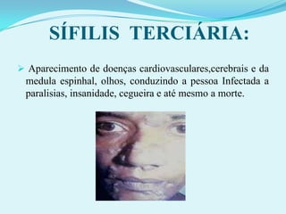 Sintomas: primeiramente prurido, fisgada e sensação de queimadura na pele dos genitais, que evoluem para lesões avermelhadas – pequenas vesículas nos genitais ou anais que se tornam muito dolorosas, as quais cicatrizam-se em algumas semanas com ou sem tratamento.