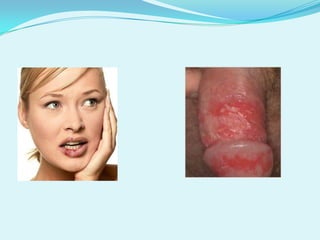  Transmissão: sexo  vaginal, anal ou oral.