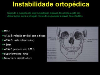 Instabilidade ortopédica
    Quando a posição de intercuspidação estável dos dentes está em
    desarmonia com a posição músculo-esqueletal estável dos côndilos




MIH
ATM E: relação estável com a fossa
ATM D: instável (inferior)
> 2mm
ATM D procura uma P.M.E.
Superiormente: mm’s
Desordens côndilo-disco
 