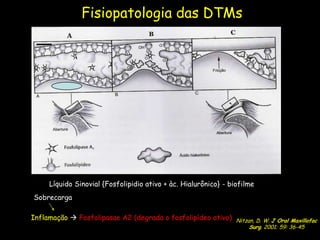Fisiopatologia das DTMs




     Líquido Sinovial {Fosfolipidio ativo + àc. Hialurônico} - biofilme
Sobrecarga

Inflamação  Fosfolipasae A2 (degrada o fosfolipídeo ativo)      Nitzan, D. W. J Oral Maxillofac
                                                                  Nitzan, D.2001; 59: 36-45
                                                                      Surg. W. J Oral Maxillofac
                                                                       Surg. 2001; 59: 36-45
 