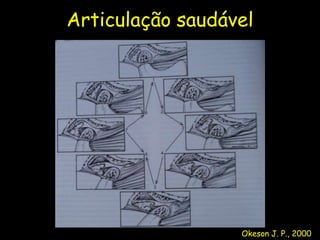 Articulação saudável




                  Okeson J. P., 2000
 