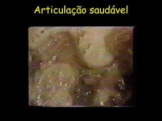 Articulação saudável
 