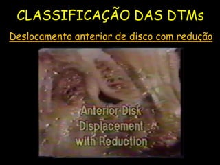 CLASSIFICAÇÃO DAS DTMs
Deslocamento anterior de disco com redução
UFMS/NHU
 