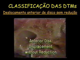 CLASSIFICAÇÃO DAS DTMs
Deslocamento anterior de disco sem redução
 