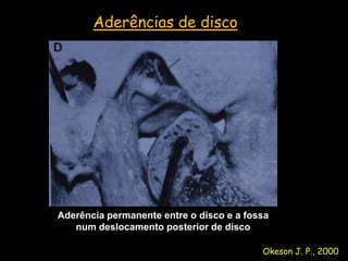 Aderências de disco




Aderência permanente entre o disco e a fossa
   num deslocamento posterior de disco

                                          Okeson J. P., 2000
 
