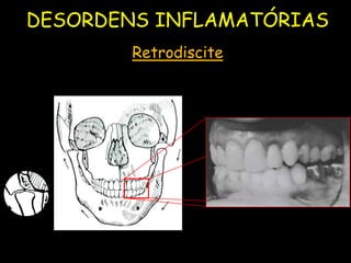 DESORDENS INFLAMATÓRIAS
        Retrodiscite
 