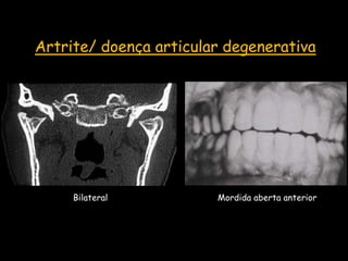 Artrite/ doença articular degenerativa




     Bilateral          Mordida aberta anterior
 