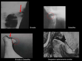 Erosão                             Osteófito




Erosão e Osteófito        Desgaste e aplainamento condilar
 