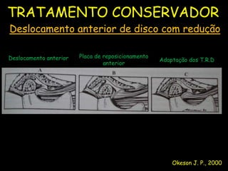 TRATAMENTO CONSERVADOR
Deslocamento anterior de disco com redução

Deslocamento anterior   Placa de reposicionamento
                                                    Adaptação dos T.R.D
                                 anterior




                                                        Okeson J. P., 2000
 