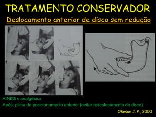TRATAMENTO CONSERVADOR
 Deslocamento anterior de disco sem redução




AINES e analgésico
Após: placa de posicionamento anterior (evitar redeslocamento do disco)
                                                          Okeson J. P., 2000
 