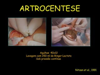 ARTROCENTESE
UFMS/NHU




                      Agulhas 40x12
            Lavagem com 250 ml de Ringer Lactato
                   Sob pressão contínua



                                                   Nitzan et al., 1991
 