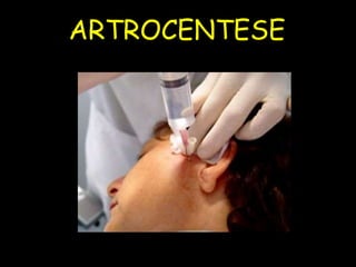 ARTROCENTESE
 